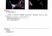 广州玛莱妇产医院B超单,宫腔积液超声影像报告单