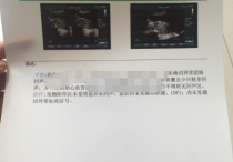 崇州市人民医院B超单,孕6周先兆流产彩超检查报告单